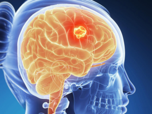 Gejala Tumor Otak Pada Penderita